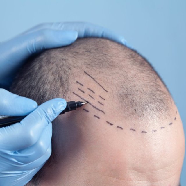 Natural Scalp | New York Scalp Micropigmentation Clinic